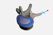RESADISC perkutana dekompresija diska QMR elektrodom